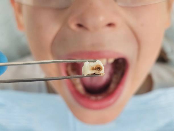 Best Emergency Root Canal Treatment in Atwood, IL